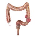 Colon cancer