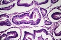 Colon cancer, light micrograph Royalty Free Stock Photo