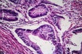 Colon cancer, light micrograph Royalty Free Stock Photo