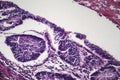 Colon cancer, light micrograph Royalty Free Stock Photo