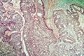 Colon carcinoma arising from adenoma, Royalty Free Stock Photo