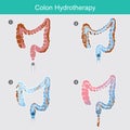 Colon Hydrotherapy..The secreted of waste that accumulates in the colon wall for a long time.