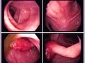 Colon Polyp: Endoscope inside colonoscopy for Colon polyps search. Colon cancer. Royalty Free Stock Photo