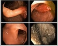 Colon Polyp: Endoscope inside colonoscopy for Colon polyps search. Colon cancer Royalty Free Stock Photo