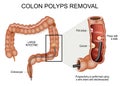 Colon polyps removal. Colonoscopy and Polypectomy