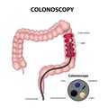 Colonoscopy