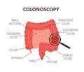 Colonoscopy concept. Intestine exam and treatment. Bowel polypectomy procedure. Anatomy of colon. Prevention of cancer