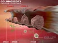 Colonoscopy examination colon digestive system