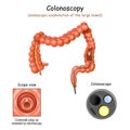 Colonoscopy in the large bowel