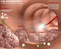 Colonoscopy and probe