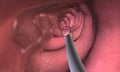 Colonoscopy is a procedure that allows you to see inside your entire large intestine