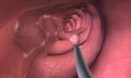 Colonoscopy is a procedure that allows you to see inside your entire large intestine