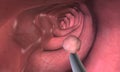 Colonoscopy is a procedure that allows you to see inside your entire large intestine