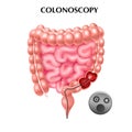 Colonoscopy Realistic Poster