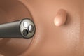 Colonoscopy technology concept