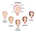 Color of amniotic fluid in the amniotic sac. normal and danger variants.