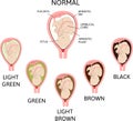 Color of amniotic fluid in the amniotic sac. normal and danger variants.