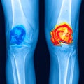 Color-Enhanced X-ray of Knee Joint Inflammation Royalty Free Stock Photo