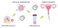 Colored in vitro fertilization IVF flat infographics with steps of additional techniques vector illustration. Ruptured follicle,