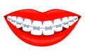 Colorful cartoon healthy smile in braces