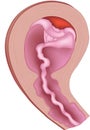 Vector illustration of placental abruption and expulsion