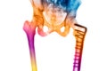 Colorful x-rays image show broken hip joint Royalty Free Stock Photo
