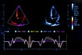 Colourful image of homan heart ultrasound monitor