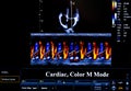 Colourful ultrasound monitor image. Cardiac