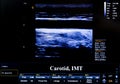 Colourful ultrasound monitor image. Carotid artery