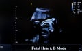 Colourful ultrasound monitor image. Fetal Heart, B mode