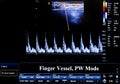 Colourful ultrasound monitor image. Finger Vessel