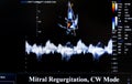 Colourful ultrasound monitor image. Mitral Regurgitation