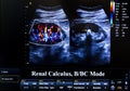 Colourful ultrasound monitor image. Renal Calculus