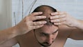 Combating hair loss in men. Injections to the head. Treatment for male pattern baldness. Early hair loss. A man uses a