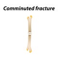 Comminuted fracture Bone. Infographics. Vector illustration on a lined background.