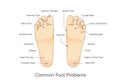 Common foot problems. Royalty Free Stock Photo