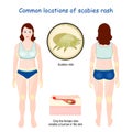 Common locations of scabies rash Royalty Free Stock Photo