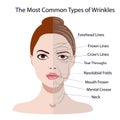 Common Types of Facial Wrinkles. cosmetic surgery. woman facial treatment