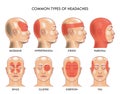 Common types of headaches