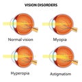 Common vision disorders. Royalty Free Stock Photo