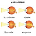 Common vision disorders. Royalty Free Stock Photo