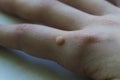 Common wart Verruca vulgaris a flat wart commonly found on the hand of children and adults. They are caused by a type of