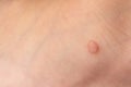 Common wart Verruca vulgaris on the skin of a child.