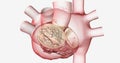 Mitral valve stenosis is the stiffening and narrowing of the hea