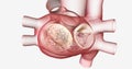 Mitral valve stenosis is the stiffening and narrowing of the hea