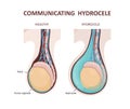 Communicating hydrocele. Testicular disease.