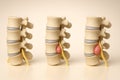 Comparative 3D illustration of lumbar intervertebral disc herniation stages showing protrusion, herniation with nerve compression Royalty Free Stock Photo