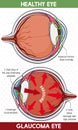 Comparative Information Between Healthy Eye and Glaucoma Eye, Vector Illustration Royalty Free Stock Photo