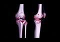 Compare AP and lateral view of CT knee joint 3D rendering image showing fracture tibia bone