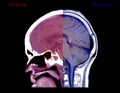 Compare CT Brain and MRI Brain sagittal view .
